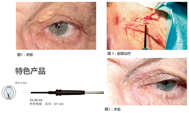 射頻刀手術(shù)圖片